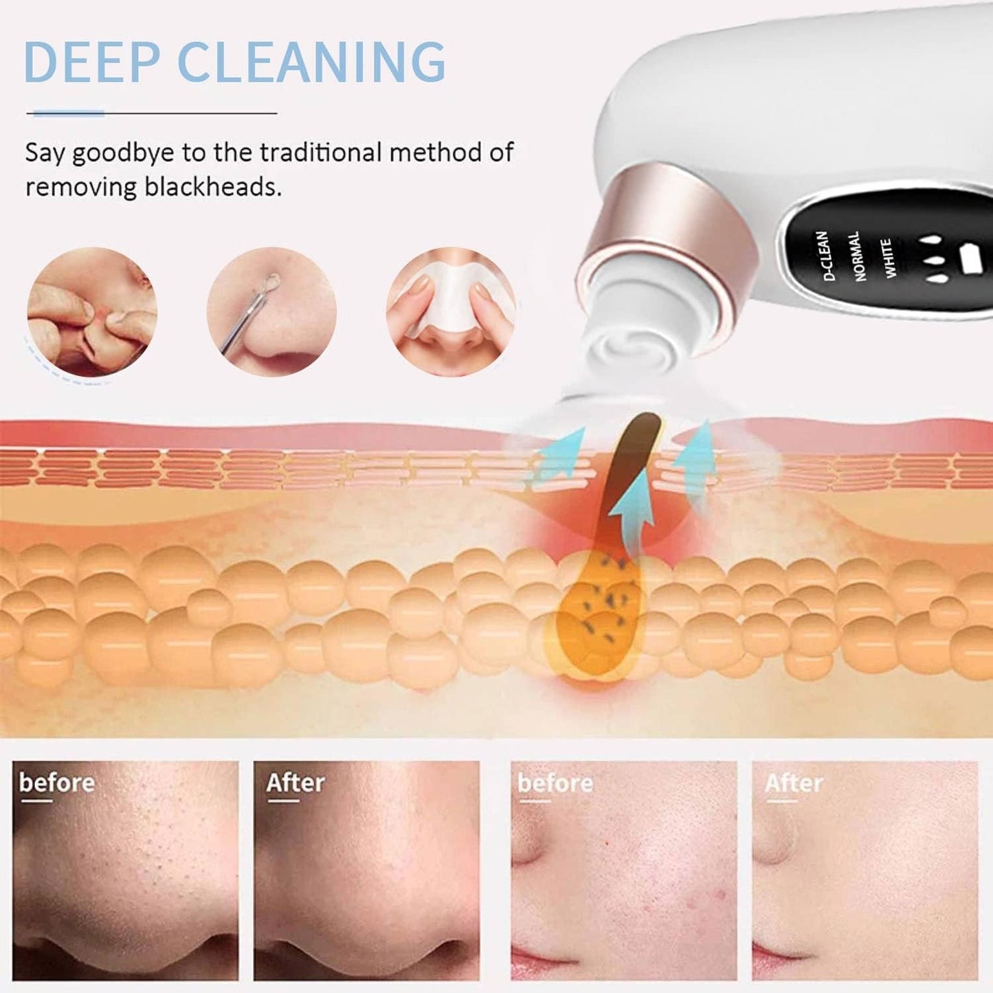 Blackhead Remover
